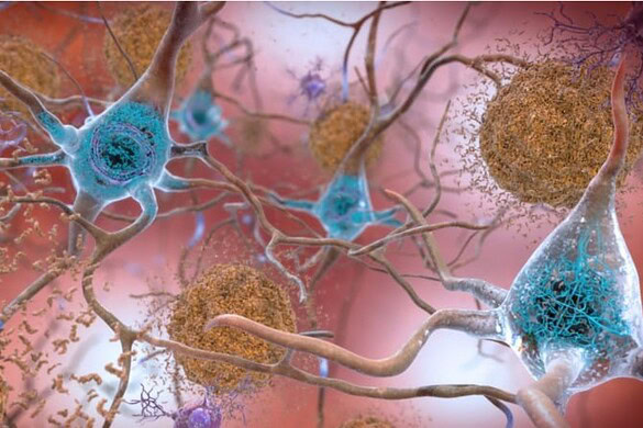 Alzheimer, nuovo farmaco anti-tau rallenta la perdita di memoria