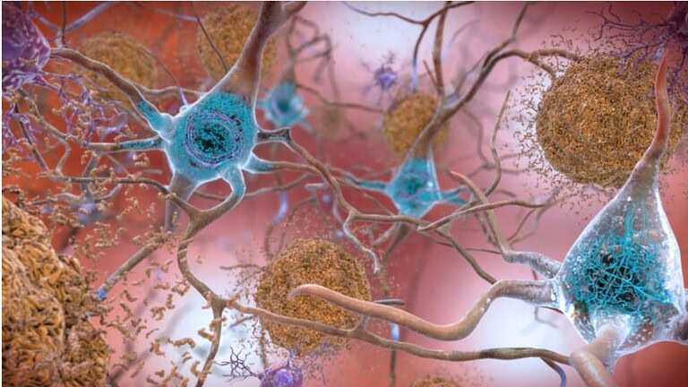 Alzheimer