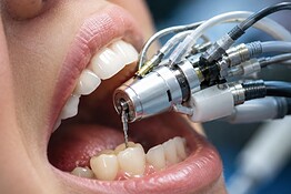 Robot dentale MIR: la corona in una sola visita dal dentista