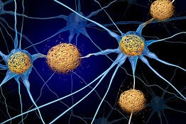 Alzheimer, scoperta la cariptosi: nuova via per fermare la morte dei neuroni