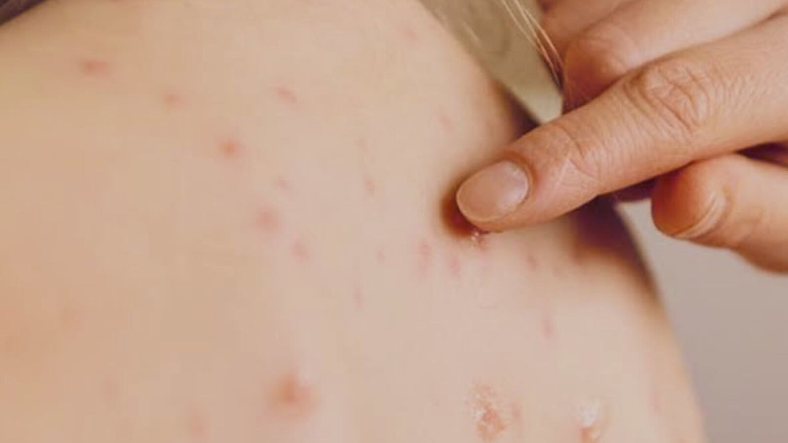 morbillo negli Stati Uniti