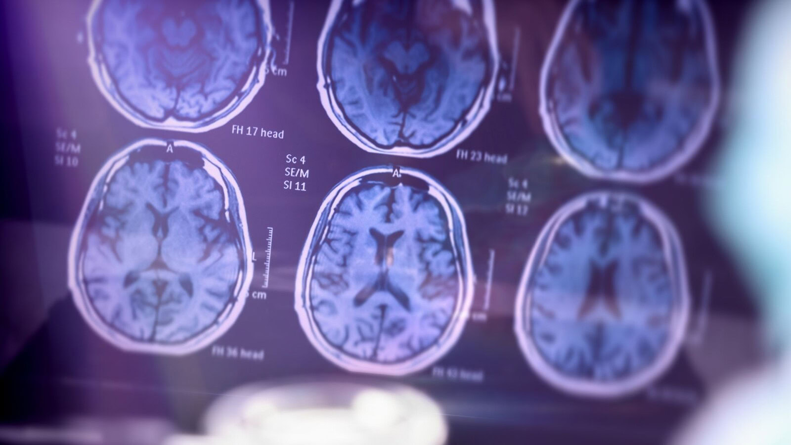 APOE4, il gene dell'Alzheimer altera il cervello anni prima