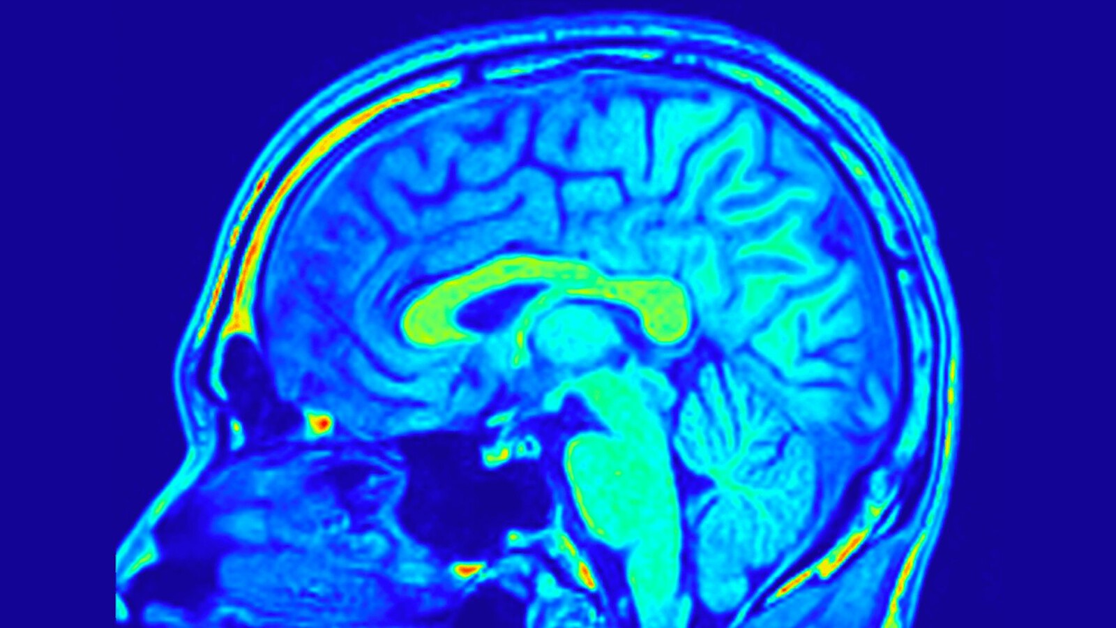 Amnesia dissociativa