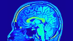 Amnesia dissociativa: memoria tornata dopo il cambio di lavoro