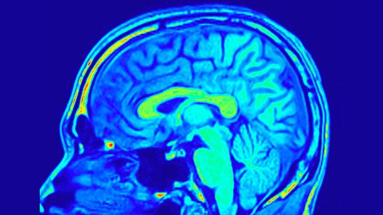 Amnesia dissociativa