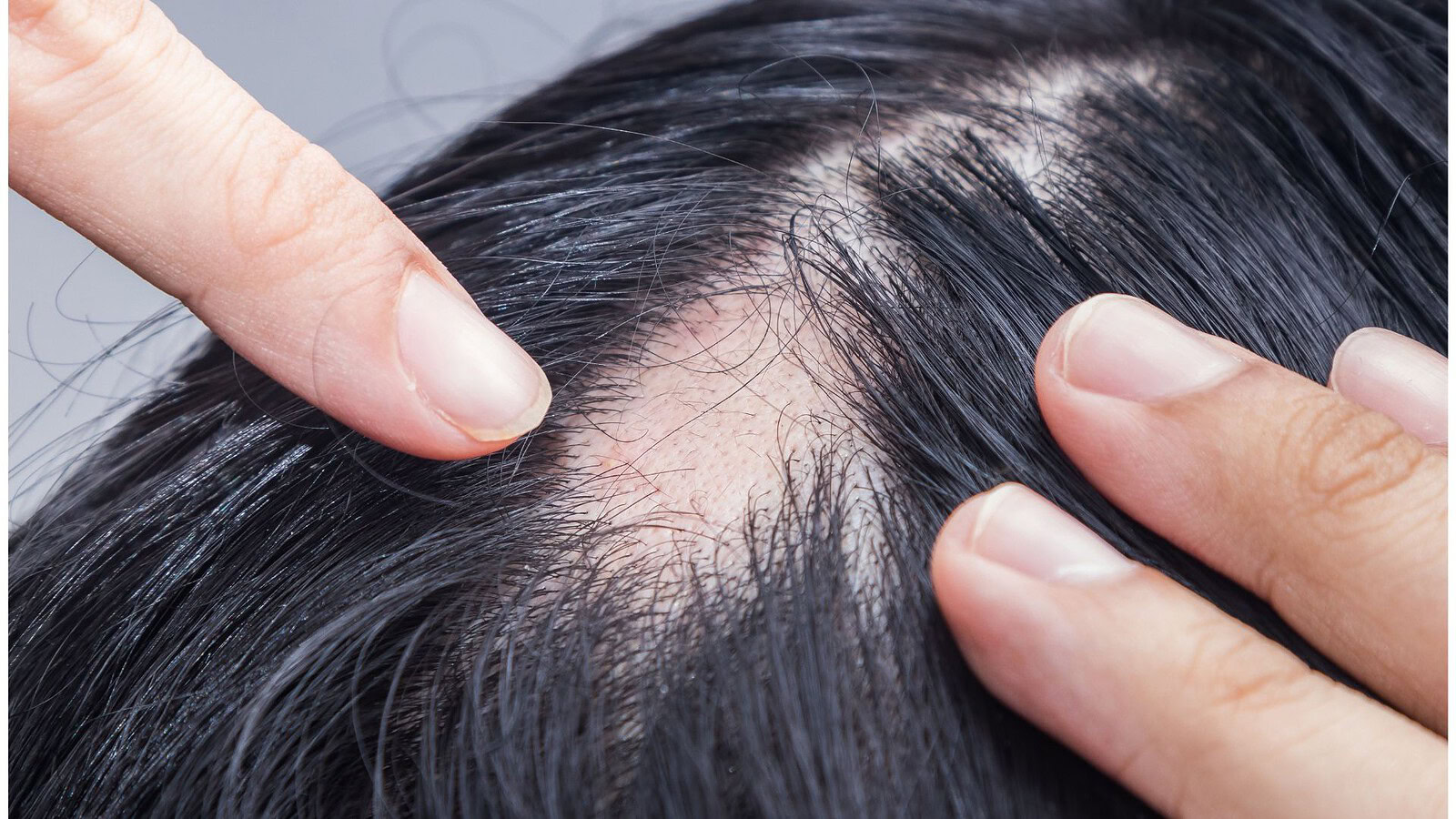 Upadacitinib e alopecia