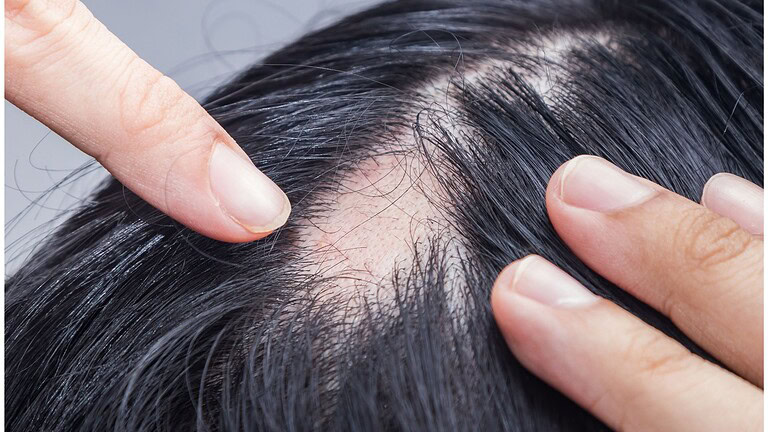 Upadacitinib e alopecia
