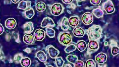 Morbillo in Pennsylvania: terza vittima, donna di 40 anni