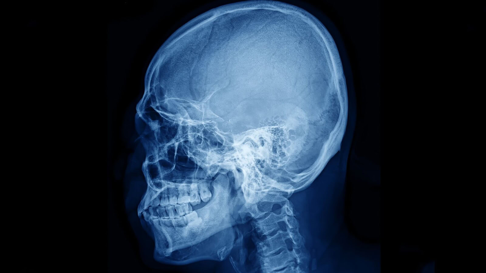 Midollo osseo del cranio: centri immunitari contro il tumore
