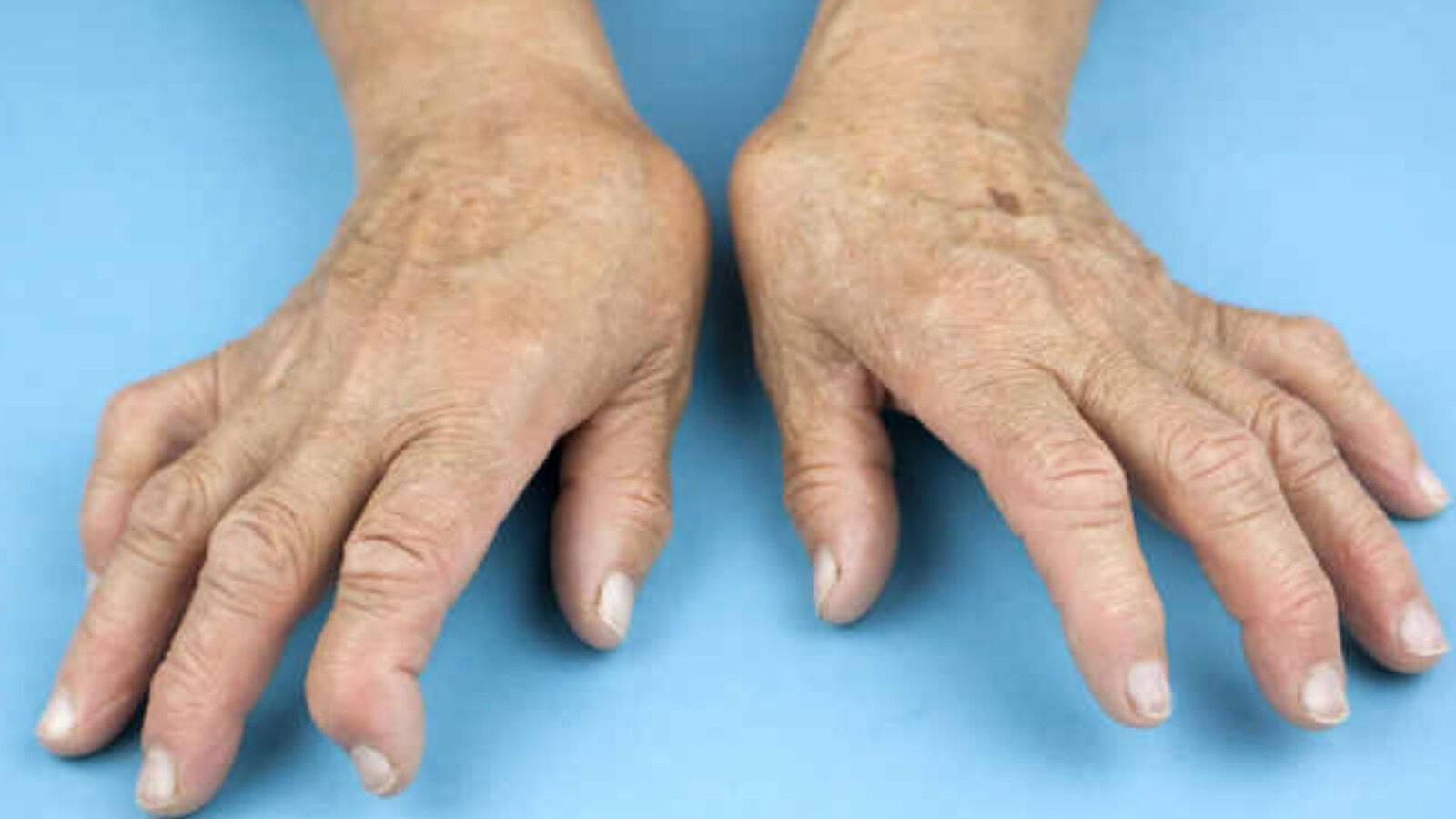 Artrite reumatoide, dolore e stanchezza oltre l'infiammazione