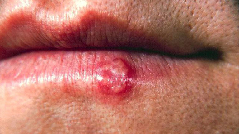 Herpes labiale