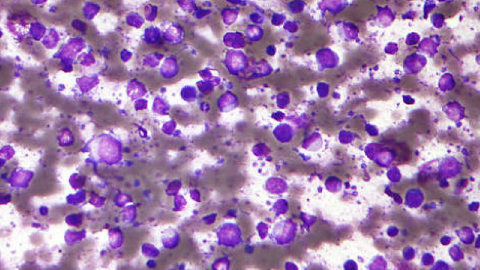 Linfoma a cellule B, molecola TCIP3 cancella i tumori nei topi