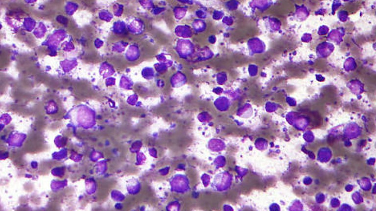 Linfoma a cellule B, molecola TCIP3 cancella i tumori nei topi